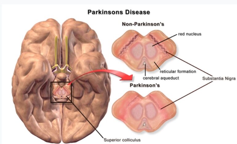  PARKINSON’S DISEASE CAUSING GENE DISCOVERED AMONG BLACK POPULATIONS